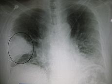 An X-ray: showing a white wedge in the right lung field of a chest X-ray.